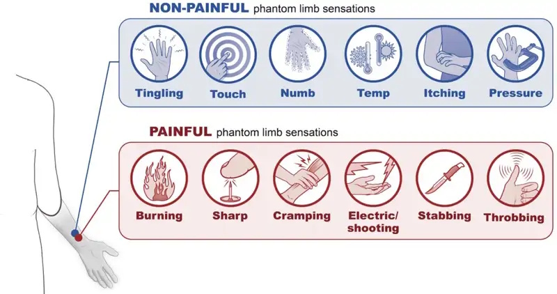 2 sensaciones del miembro fantasma